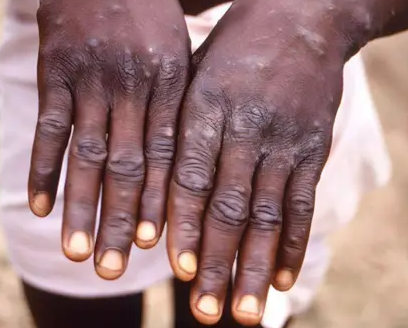 Mpox:  Síntomas y cómo se propaga la viruela. OMS declaró emergencia internacional.